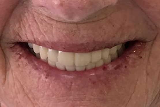 peg-after-dental-implant-service