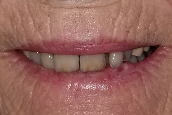 peg-before-dental-implant-service