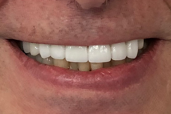 bob-dental-implant-service-after