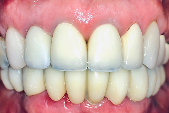 helen-after-dental-implant-service
