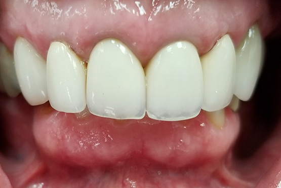 helen-before-dental-implant service