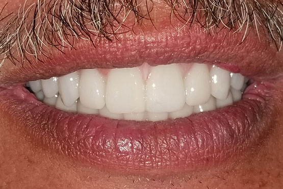 joel-after-dental-implant service
