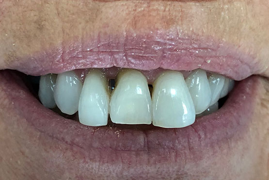 susan-before-dental-implant-service